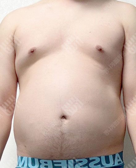 女性化乳房症4 전