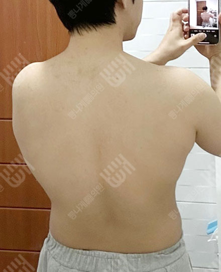 남자背中の脂肪吸引1 전