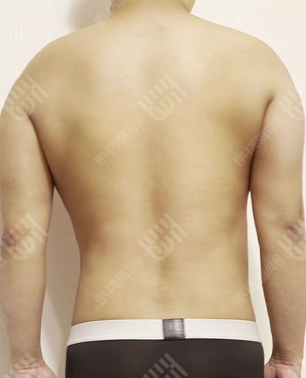 남자背中の脂肪吸引2 후