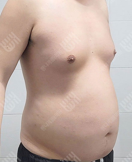 女性化乳房症3 전