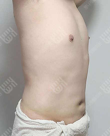女性化乳房症3 후