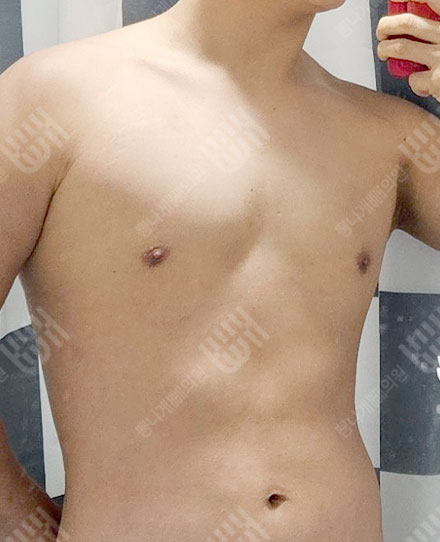 女性化乳房症2 후