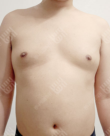 女性化乳房症5 전