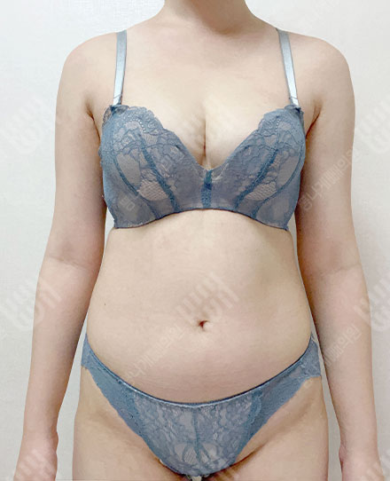 骨盤の脂肪移植10 전