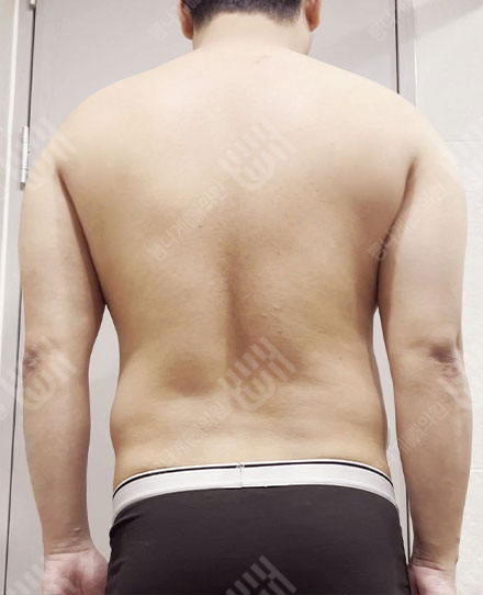 남자背中の脂肪吸引2 전
