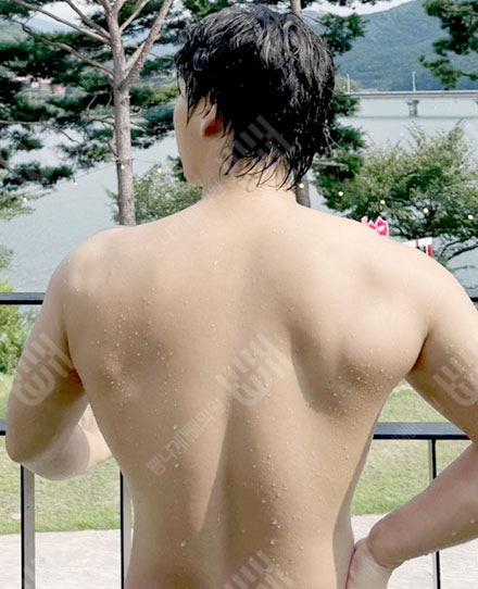 남자背中の脂肪吸引1 후