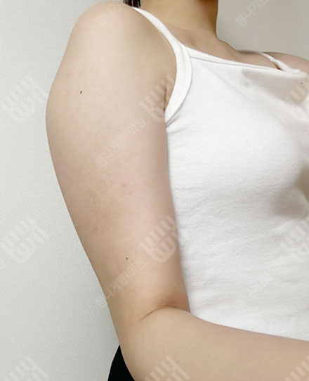 腕の脂肪吸引 3 전