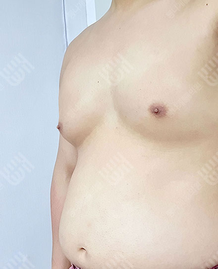 女性化乳房症2 전