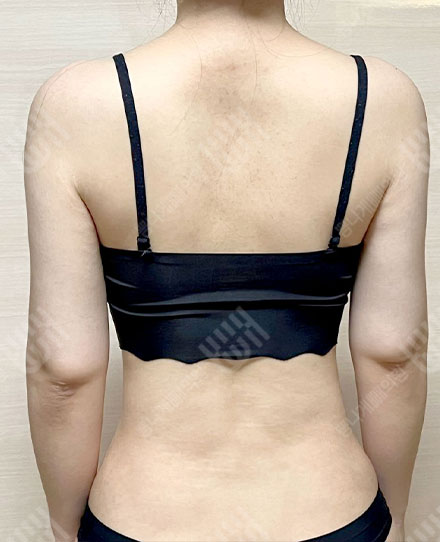背中の脂肪吸引4 후