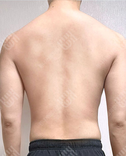 남자背中の脂肪吸引3 후