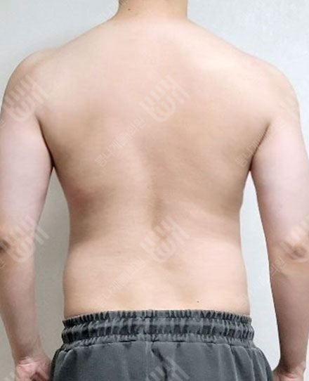 남자背中の脂肪吸引3 전