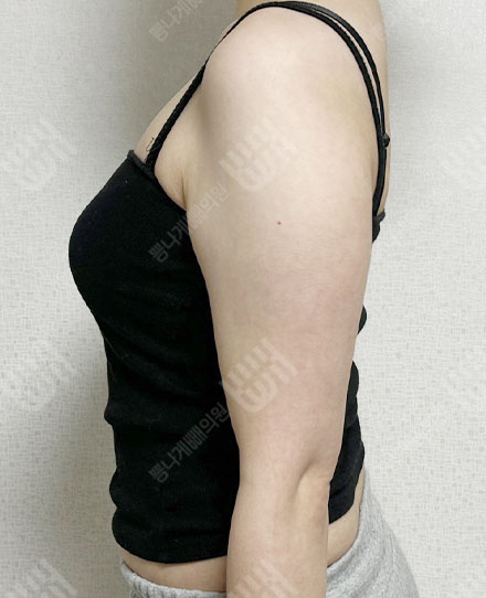 腕の脂肪吸引6 전