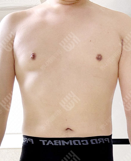 女性化乳房症4 후