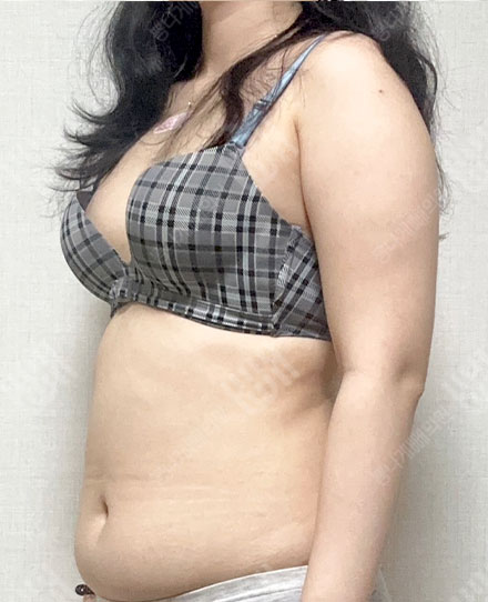 腕の脂肪吸引5 전
