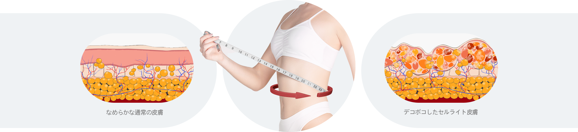 Comparison Between Normal Skin and Cellulite-Affected Skin