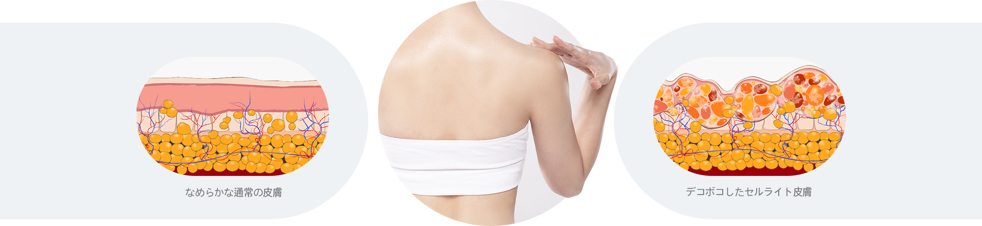 Comparison Between Normal Skin and Cellulite-Affected Skin