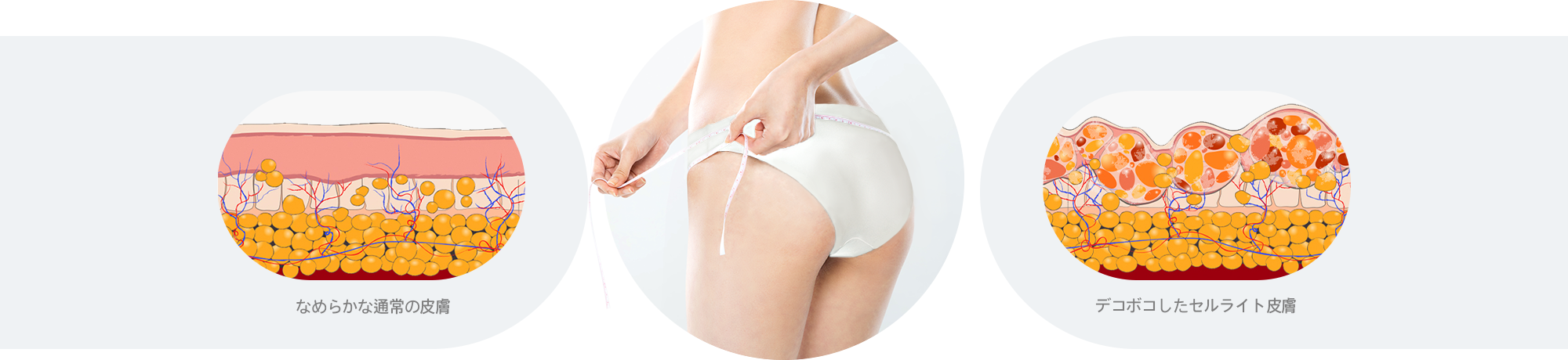 Comparison Between Normal Skin and Cellulite-Affected Skin