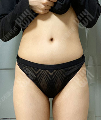 Before: 手術前