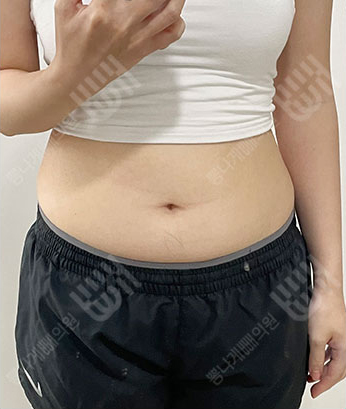 Before: 手術前
