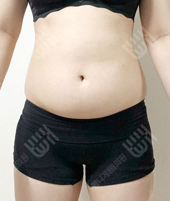 Before: 手術前