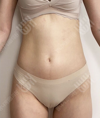 Before: 手術前