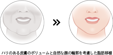 ハリのある皮膚のボリュームと自然な顔の輪郭を考慮した脂肪移植