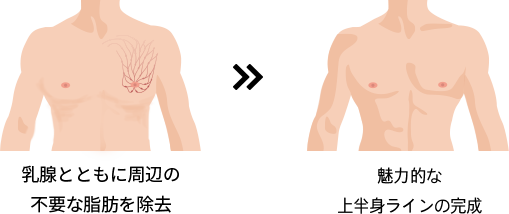 乳腺とともに周辺の不要な脂肪を除去>> 魅力的な上半身ラインの完成