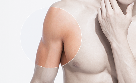 Accessory breast
