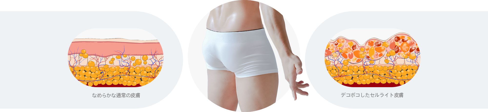 なめらかな通常の皮膚 or デコボコしたセルライト皮膚